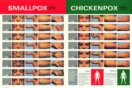 Stages of rash for smallpox and chickenpox